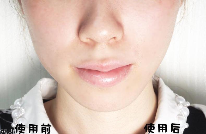 tripollar stop好用吗 媲美超声刀