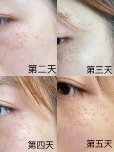 ​皮秒祛斑后恢复过程（实拍无美颜）