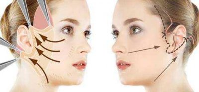 ​最近很火的线雕到底是啥？