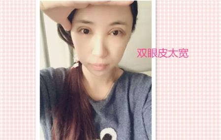 这些都是割双眼皮失败案例图片，看完你还敢割双眼皮吗？