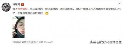 ​马思纯都躲不过的“带状疱疹”疼起来究竟多严重