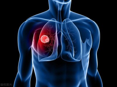 ​肺部有癌，睡眠先知？睡觉出现4种情况，或是癌症发出的信号