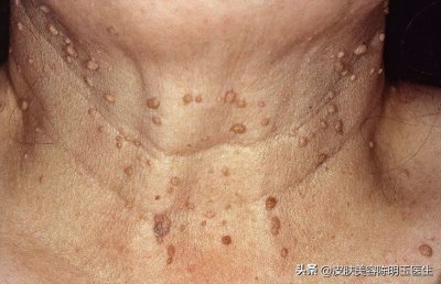 ​脖子长了很多小肉粒，是身体出毛病了吗？有哪些适合的治疗方法