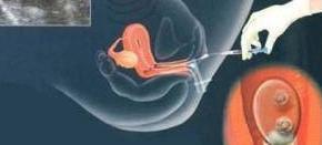 为什么明星容易生双胞胎?知道这些你还愿意做吗?