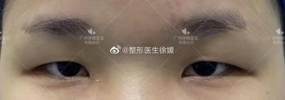 ​到底什么是肿眼泡？