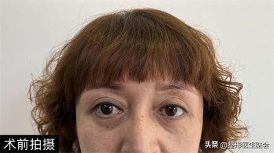 ​50岁大姐两次眼袋手术失败，膨体填充后儿子惊叹：妈 你像换了个人
