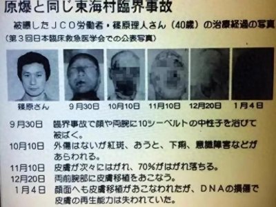 ​东海村临界事件：一小伙看着自己身体融化