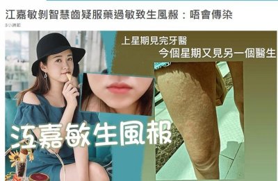 ​26岁女星江嘉敏拔牙后药物过敏，导致全身瘙痒，腿上长满小疙瘩