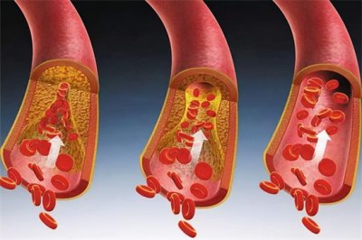 ​血管堵塞吃什么食物好疏通（血管问题无小事！常吃这几种食物，或可疏通血管，